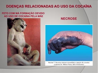 DOENÇAS RELACIONADAS AO USO DA COCAÍNA
NECROSE
FETO COM MÁ FORMAÇÃO DEVIDO
AO USO DE COCAÍNA PELA MÃE
 