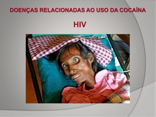 DOENÇAS RELACIONADAS AO USO DA COCAÍNA
HIV
 