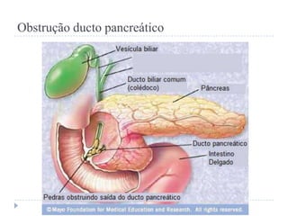 Obstrução ducto pancreático

 