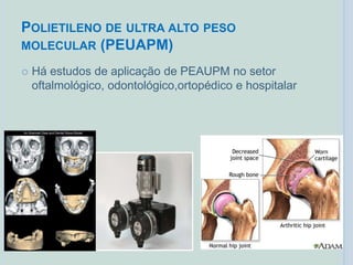 POLIETILENO DE ULTRA ALTO PESO
MOLECULAR (PEUAPM)
 Há estudos de aplicação de PEAUPM no setor
oftalmológico, odontológico,ortopédico e hospitalar
 