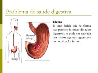 Problema de saúde digestiva
Úlcera
É uma ferida que se forma
nas paredes internas do tubo
digestório e pode ser causada
por vários agentes agressores
como: álcool e fumo.

 