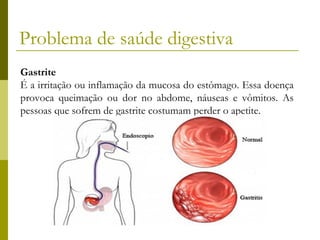Problema de saúde digestiva
Gastrite
É a irritação ou inflamação da mucosa do estômago. Essa doença
provoca queimação ou dor no abdome, náuseas e vômitos. As
pessoas que sofrem de gastrite costumam perder o apetite.

 