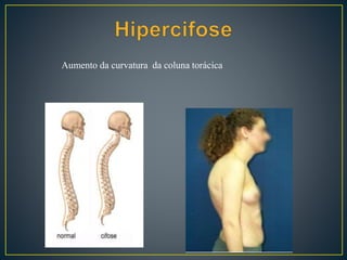 Aumento da curvatura da coluna torácica
 