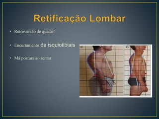 • Retroversão de quadril
• Encurtamento de isquiotibiais
• Má postura ao sentar
 