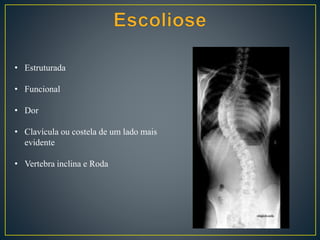 • Estruturada
• Funcional
• Dor
• Clavícula ou costela de um lado mais
evidente
• Vertebra inclina e Roda
 