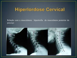 Relação com a musculatura: hipertrofia da musculatura posterior do
pescoço
 