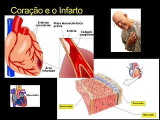 Coração e o Infarto 
 