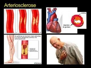 Arteriosclerose 
 