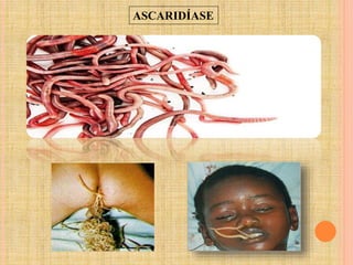 ASCARIDÍASE
 