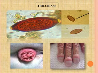 TRICURÍASE
 