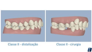 Classe II - distalização Classe II - cirurgia 
 