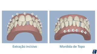 Extração incisivo Mordida de Topo 
 
