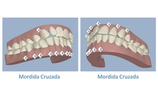 Mordida Cruzada Mordida Cruzada 
 
