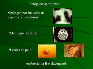Patógeno oportunista
•Infecção por inalação de
esporos ou leveduras
•Meningoencefalite
•Lesões de pele
Anfotericina B e fluconazol
 
