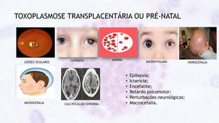 TOXOPLASMOSE TRANSPLACENTÁRIA OU PRÉ-NATAL
CATARATA ANEMIA
MICROFITALMIA
LESÕES OCULARES
MICROCEFALIA
HIDROCEFALIA
CALCIFICAÇÃO CEREBRAL
• Epilepsia;
• Icterícia;
• Encefalite;
• Retardo psicomotor;
• Perturbações neurológicas;
• Macrocefalia.
 