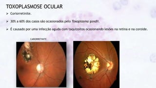 TOXOPLASMOSE OCULAR
CARIORRETINITE
 Coriorretinite.
 30% a 60% dos casos são ocasionados pelo Toxoplasma gondii.
 É causado por uma infecção aguda com taquizoítos ocasionando lesões na retina e na coroide.
 