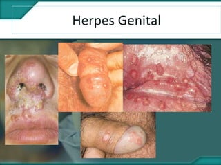 Herpes Genital
 