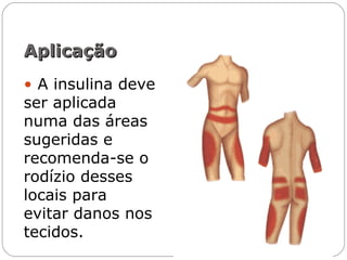 • A insulina deve
ser aplicada
numa das áreas
sugeridas e
recomenda-se o
rodízio desses
locais para
evitar danos nos
tecidos.
AplicaçãoAplicação
 