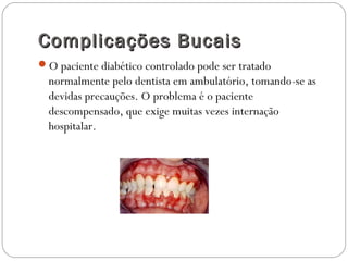 Complicações BucaisComplicações Bucais
O paciente diabético controlado pode ser tratado
normalmente pelo dentista em ambulatório, tomando-se as
devidas precauções. O problema é o paciente
descompensado, que exige muitas vezes internação
hospitalar.
 