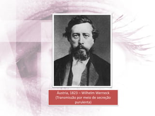 Áustria, 1823 – Wilhelm Werneck
(Transmissão por meio de secreção
purulenta)
 