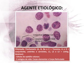 AGENTE ETIOLÓGICO:
Chlamydia Trachomatis (A, B, Ba e C = Tracoma, A e K =
conjuntivite, uretrites e cervicites, L1, L2 e L3 = Linfog.
Venéreo):
- Células do epitélio colunar;
- 2 estágios de vida: Corpo elementar e Corpo Reticulado
 