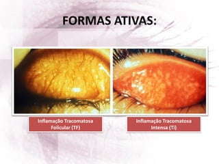 FORMAS ATIVAS:
Inflamação Tracomatosa
Folicular (TF)
Inflamação Tracomatosa
Intensa (Ti)
 