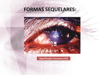FORMAS SEQUELARES:
Opacificação Corneana (CO)
 