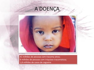 A DOENÇA
41 milhões de pessoas com tracoma ativo;
8 milhões de pessoas com triquíase tracomatosa;
1,8 milhões de casos de cegueira
 