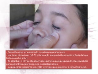 - Cada olho deve ser examinado e avaliado separadamente;
- Use lupas binoculares (x2, 5) e iluminação adequada (Iluminação própria da lupa,
lanterna ou luz solar);
- As pálpebras e córnea são observados primeiro para pesquisa de cílios invertidos
para conjuntiva ocular ou córnea e opacidade desta.
- As pálpebras superiores são então invertidas para examinar a conjuntiva tarsal.
 
