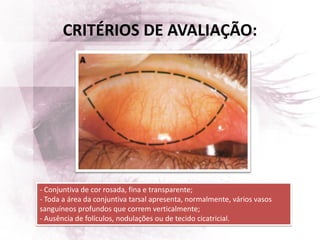 CRITÉRIOS DE AVALIAÇÃO:
- Conjuntiva de cor rosada, fina e transparente;
- Toda a área da conjuntiva tarsal apresenta, normalmente, vários vasos
sanguíneos profundos que correm verticalmente;
- Ausência de folículos, nodulações ou de tecido cicatricial.
 