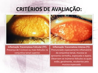 CRITÉRIOS DE AVALIAÇÃO:
Inflamação Tracomatosa Folicular (TF):
Presença de 5 (cinco) ou mais folículos na
conjuntiva tarsal superior.
Inflamação Tracomatosa Intensa (Ti):
Pronunciado espessamento inflamatório
da conjuntiva tarsal, mucosa se
apresenta vermelha, espessada e áspera.
Observam-se inúmeros folículos os quais
estão, geralmente, recobertos pela
mucosa espessada
 