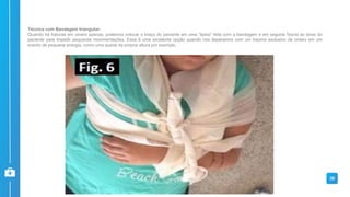 Técnica com Bandagem triangular:
Quando há fraturas em úmero apenas, podemos colocar o braço do paciente em uma “tipóia” feita com a bandagem e em seguida fixa-la ao tórax do
paciente para impedir pequenas movimentações. Essa é uma excelente opção quando nos deparamos com um trauma exclusivo de úmero em um
evento de pequena energia, como uma queda da própria altura por exemplo.
39
 