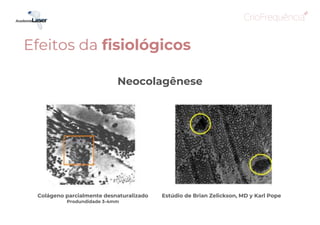 Neocolagênese
Colágeno parcialmente desnaturalizado
Produndidade 3-4mm
Estúdio de Brian Zelickson, MD y Karl Pope
Efeitos da fisiológicos
 