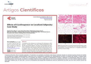 Artigos Científicos
O estudo de Silva [9], utilizou 6 sessões aplicadas a 15 pacientes e os resultados encontrados neste estudo mostraram redução da camada de gordura através de medidas
de circunferência e imagens ultrassonográficas, observando que a criofrequência (crioterapia com radiofrequência) foi eficaz na redução das medidas. A eficácia dessa
tecnologia foi demonstrada em um estudo com 35 voluntários que realizou 4 sessões de radiofrequência. Durante o tratamento, as temperaturas atingiu 46˚C para a
camada de gordura e 42˚C na pele, ao analisar os resultados observou-se diminuição média de 4,93 cm da circunferência da cintura, com leve a eritema moderado relatado
como efeito colateral [16]. Por outro lado, o uso de a criofrequência não atinge altas temperaturas devido ao resfriamento da ponta, que traz maior conforto durante sua
aplicação.
 