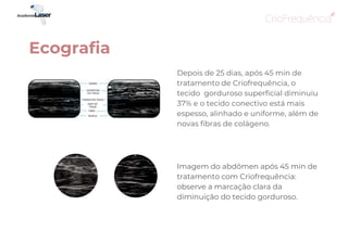 Ecografia
Depois de 25 dias, após 45 min de
tratamento de Criofrequência, o
tecido gorduroso superficial diminuiu
37% e o tecido conectivo está mais
espesso, alinhado e uniforme, além de
novas fibras de colágeno.
Imagem do abdômen após 45 min de
tratamento com Criofrequência:
observe a marcação clara da
diminuição do tecido gorduroso.
 
