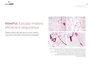 Destruição da gordura com vasos,
nervos e tecido conectivo intactos.
HImFU: Estudo mostra
eficácia e segurança
Fonte: Characterization of Non-thermal Focused Ultrasound
for Non-invasive Selective fat Cell Disruption (lysis):
Technical and Pre-clinical Assessment. Spencer A. Brown1,
Lior Greenbaum2, Stella Shtukmaster2, Yehuda
Zadok2,Shmuel Ben-Ezra2 and Leonid Kushkuley2.
Ultrashape 2006
 