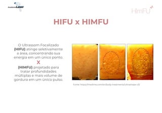 HIFU x HIMFU
O Ultrassom Focalizado
(HIFU) atinge seletivamente
a área, concentrando sua
energia em um único ponto.
X
(HIMFU) projetado para
tratar profundidades
múltiplas e mais volume de
gordura em um único pulso.
Fonte: https://medime.com/en/body-treatments/ultrashape-v3/
 