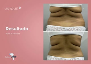 Resultado
Após 4 sessões
 