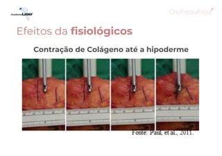 Contração de Colágeno até a hipoderme
Efeitos da fisiológicos
 