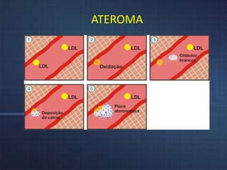 ATEROMA 
 