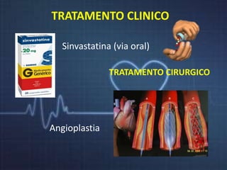 TRATAMENTO CLINICO 
Sinvastatina (via oral) 
TRATAMENTO CIRURGICO 
Angioplastia 
 