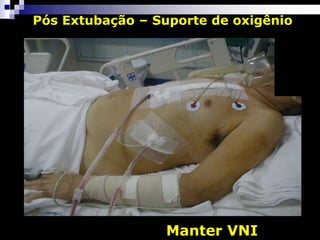 Pós Extubação – Suporte de oxigênio
Manter VNI
 