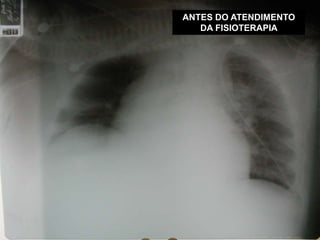 ANTES DO ATENDIMENTO
DA FISIOTERAPIA
 