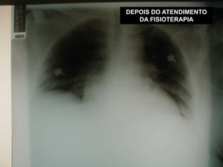 DEPOIS DO ATENDIMENTO
DA FISIOTERAPIA
 