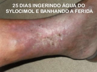 25 DIAS INGERINDO ÁGUA DO
SYLOCIMOL E BANHANDO A FERIDA

 