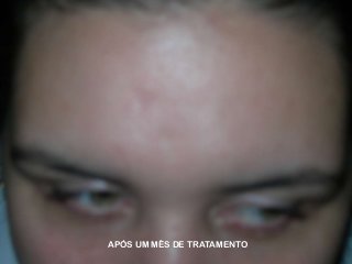 APÓS UM MÊS DE TRATAMENTO

 
