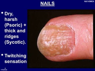 © Subrata
NAILS
•Dry,
harsh
(Psoric) +
thick and
ridges
(Sycotic).
•Twitching
sensation
.
NUX VOMICA
 