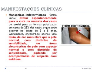 MANIFESTAÇÕES CLÍNICAS
 Hanseníase indeterminada – forma
inicial, evolui espontaneamente
para a cura na maioria dos casos
ou evolui para as formas polarizadas
em cerca de 25% dos casos, o que pode
ocorrer no prazo de 3 a 5 anos.
Geralmente, encontra-se apenas uma
lesão, de cor mais clara que a pele
normal, com distúrbio da
sensibilidade, ou áreas
circunscritas de pele com aspecto
normal e com distúrbio de
sensibilidade, podendo ser
acompanhadas de alopecia e/ou
anidrose.
By Ismael Costa65
 