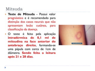 Mitsuda
 Teste de Mitsuda - Possui valor
prognóstico e é recomendado para
distinção dos casos neurais que não
apresentam lesão cutânea, para
classificação da doença.
 O teste é feito pela aplicação
intradérmica de 0,1 ml de
mitsudina na face anterior do
antebraço direito, formando-se
uma pápula com cerca de 1cm de
diâmetro. Sendo feita a leitura
após 21 e 28 dias.
 