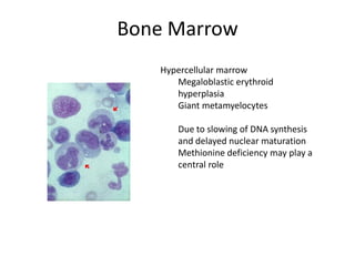 Bone Marrow
Hypercellular marrow
Megaloblastic erythroid
hyperplasia
Giant metamyelocytes
Due to slowing of DNA synthesis
and delayed nuclear maturation
Methionine deficiency may play a
central role
 